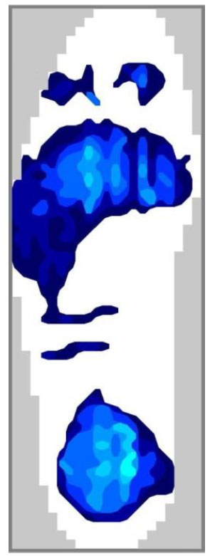 répartition de la pression des pieds