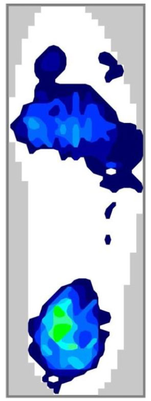 répartition de la pression des pieds